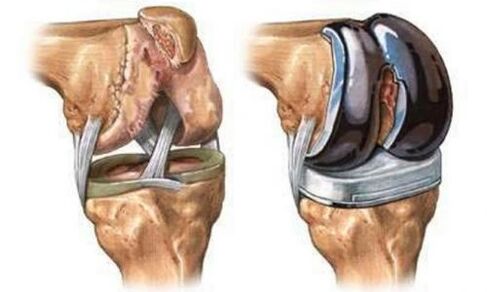 Arthroz için diz ekleminin endoprostetikleri