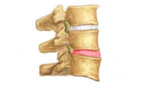 Omurganın intervertebral diskinin çıkıntısı - osteokondroz belirtisi