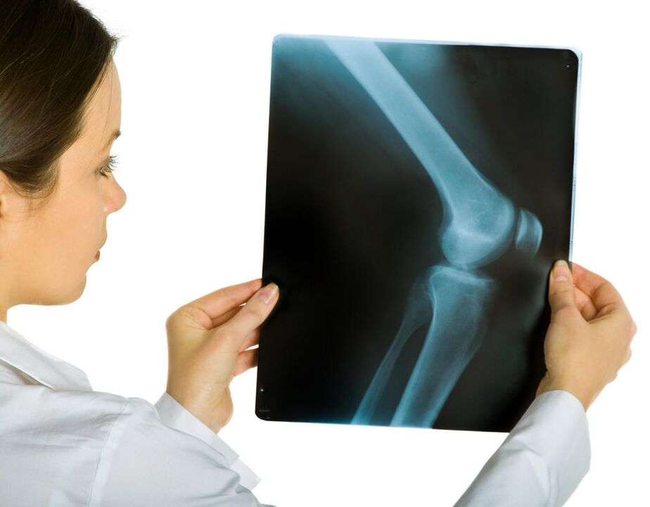 Diz ekleminin röntgeni, deforme artrozun varlığını ortaya çıkaracaktır. 